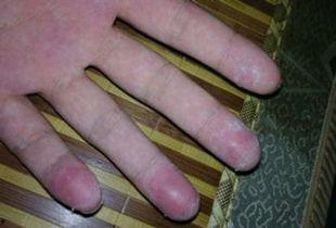 手癣可以吃梨瓜吗,天然润肤佳品