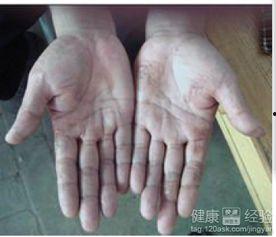 手癣可以吃梨瓜吗,天然润肤佳品